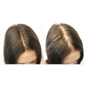 Özel Saç Çıkaran SET BAYAN ve ERKEKLERE 