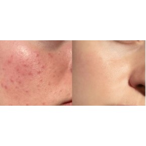 AKNE KONTROL  SETI 3 LU PAKET